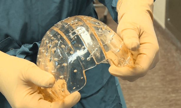 Dutch hospital 3D prints woman a new skull
